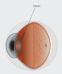 Cataract Anatomy